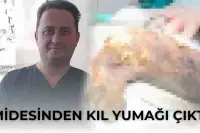 Midesinden Kıl Yumağı Çıktı! Doktorlar Gördüğüne İnanamadı!