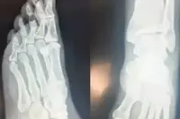 Özgür Özel Daha Fazla Dayanamadı! Röntgen Filmlerini Paylaştı