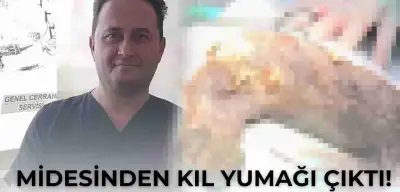 Midesinden Kıl Yumağı Çıktı! Doktorlar Gördüğüne İnanamadı!