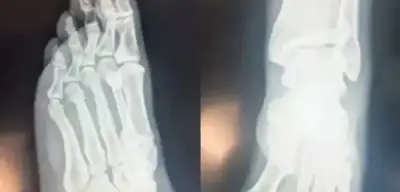 Özgür Özel Daha Fazla Dayanamadı! Röntgen Filmlerini Paylaştı