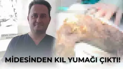 Midesinden Kıl Yumağı Çıktı! Doktorlar Gördüğüne İnanamadı!